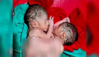 Conjoined-head twins sent to Dhaka from Patuakhali